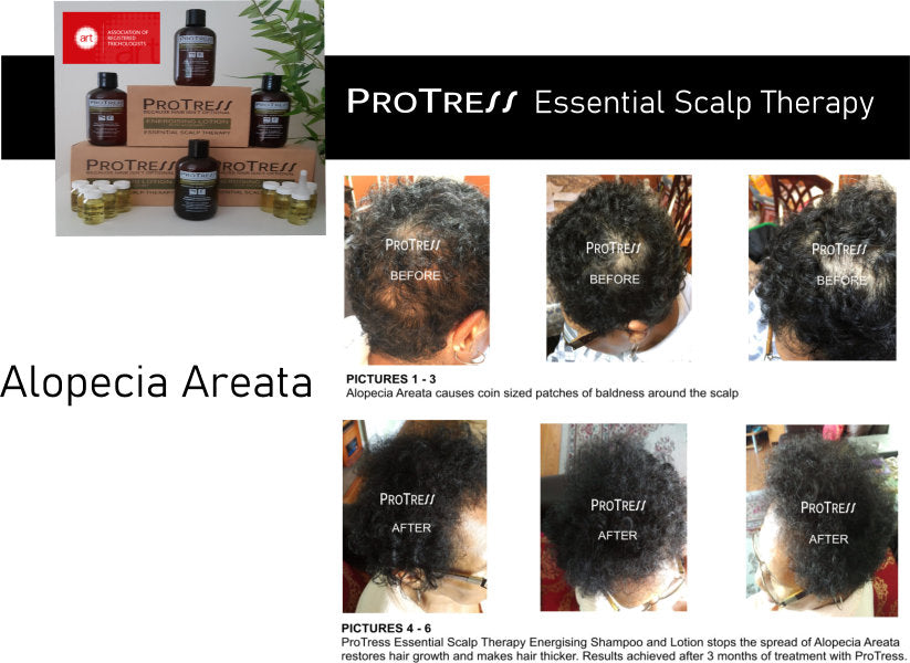 Alopecia Areata